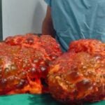 Ways to protect the kidneys from kidney failure and disease